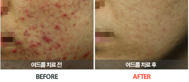 여드름치료전후사진
