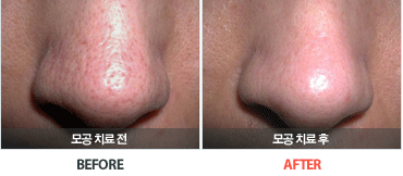 흉터/모공치료전후사진