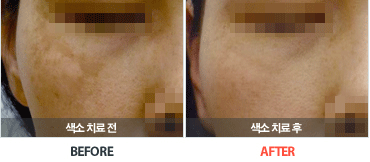 기미치료전후사진
