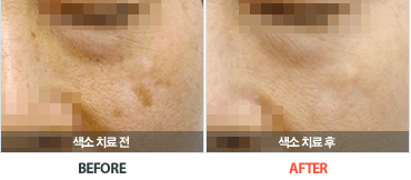 색소치료전후사진